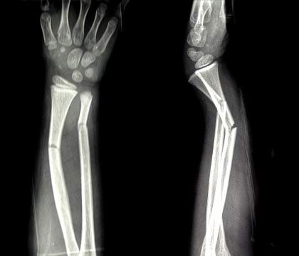 Murdunud käeluu röntgenpilt